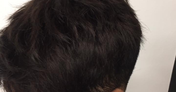 get_the_best_Alopecia_ad