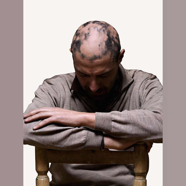 get_the_best_Alopecia Areata_ad
